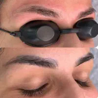 ریمو ابرو بدون زخم