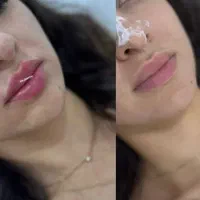 فیلر لب،چونه،گونه،فول فیس،باسن|خدمات آرایشگری و زیبایی|مشهد, سجاد شهر|دیوار