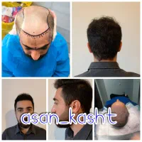 بیا و ببین کاشت مو وابرو