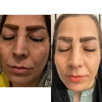 لیزر سفید کننده بدن