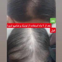 پک رویش مجددموهای ازدست رفته