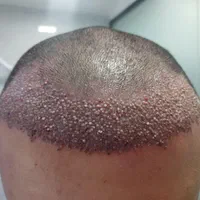 کاشت مو  تخصصی  تخفیف ۲۰درصدی مارو از دست ندهید|خدمات آرایشگری و زیبایی|اهواز, کیانپارس |دیوار