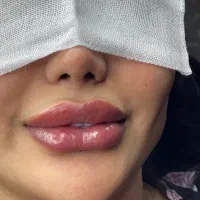 ترزیق ژل و بوتاکس،تخصصی و تضمینی