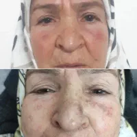 جشنواره پاک کردن تتو و حذف لک ،کک و مک تضمینی