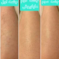 لیزر موهای زائد،مایابیوتی،ضمانت برگشت پول