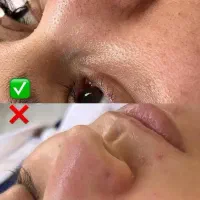 پاکسازی پوست و اصلاح تخصصی درماپلنینگ