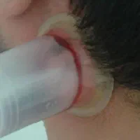 حجامت.زالودرمانی.فصدخون