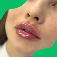 جشنواره تخفیف ژل لبروسی،فیلرشقیقه،بوتاکس توسط پزشک