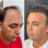 کاشت موی طبیعی و حرفه ای