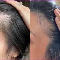 یکبار برای همیشه درمانشو