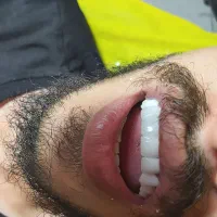 عصبکشی پر کردن ۱۳۰۰ روکش فروش رادیوگرافی|خدمات آرایشگری و زیبایی|مرند, |دیوار