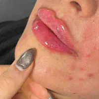 تزریق ژل بوتاکس مادلینگ و ساکشن غبغب|خدمات آرایشگری و زیبایی|تهران, آسمان|دیوار