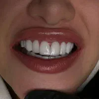 کامپوزیت ۴۰درصد تخفیف|خدمات آرایشگری و زیبایی|خرم‌آباد, |دیوار