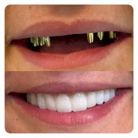 ایمپلنت یک روزه دیجیتال ۸۸۰۰