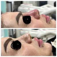 خال برداری درمان کک و مک فشیال درمطب.بانوان-اقایان