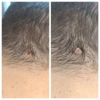 خال،زیگیل تناسلی ودرمانhpv،لک ،زائده پوستی