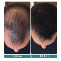 درمان کامل ریزش مو