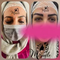 کاشت مو و ابرو طبیعی و متقارن و اصولی در یزد