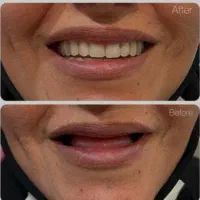 دندانساری متحرک(مصنوعی)|خدمات آرایشگری و زیبایی|اصفهان, جاوان|دیوار