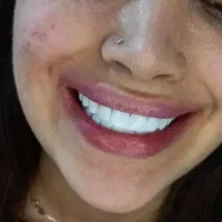 کامپوزیت دندان