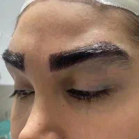 کاشت مو و ابرو وجراحی پلک باضمانتنانه وتمام اقساط|خدمات زیبایی و سلامت|تهران, نارمک|دیوار