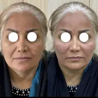 بوتاکس فیلر تخصصی و فیلر بادی و پی ارپی|خدمات آرایشگری و زیبایی|کرمانشاه, |دیوار