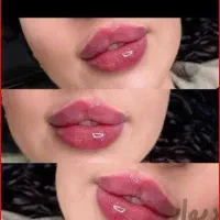 لیزر مو زائد، فشیال،پی آر پی،ژل و بوتاکس توسط پزشک|خدمات آرایشگری و زیبایی|مراغه, |دیوار