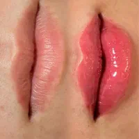 تخفیف ویژه ژل و بوتاکس|خدمات آرایشگری و زیبایی|گنبد کاووس, |دیوار