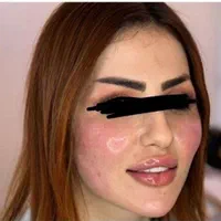 تزریق وآموزش ژل و بوتاکس چربی توسط دانشجویی پزشکی|خدمات آرایشگری و زیبایی|اهواز, زیتون کارمندی|دیوار