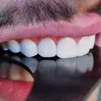 کامپوزیت دندان