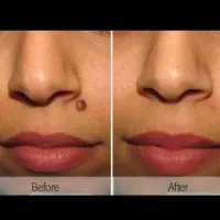 برداشتن خال ،زگیل ،میخچه ،پلکسر پلک.