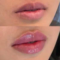 انجام خدمات زیبایی ،بوتاکس ،فیلر،مروتراپی ،مزوژل و|خدمات آرایشگری و زیبایی|تهران, نیروی هوایی (پیروزی)|دیوار