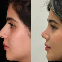 عمل جراحی بینی پیزوسرجری با بهترین کیفیت و قیمت|خدمات آرایشگری و زیبایی|رفسنجان, |دیوار