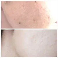 برداشتن خال ومنگوله های پوستی ولکه های سطحی بالیزر|خدمات آرایشگری و زیبایی|الیگودرز, |دیوار