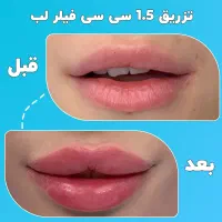 انجام بوتاکس و فیلر با بهترین برند