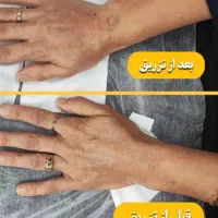 آف ۳۰% ژل بوتاکس بایوفیلر پی ارپی لاغری هایفو لیزر|خدمات آرایشگری و زیبایی|اهواز, کوی باهنر|دیوار