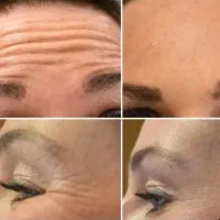 بوتاکس توسط پزشک