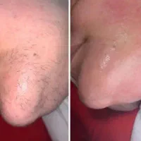 الکترولیز فسا (حذف دائمی موهای زائد)