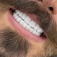 کامپوزیت دندان|خدمات آرایشگری و زیبایی|بوشهر, |دیوار