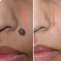 برداشت انواع خال و کک ومک