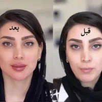 فیلر لب و بوتاکس با پنجاه درصد تخفیف|خدمات زیبایی و سلامت|تهران, صادقیه|دیوار