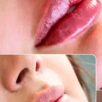 مدل ژل و بوتاکس
