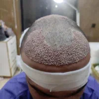 کاشت مو طبیعی له روش میکروfit وsut|خدمات آرایشگری و زیبایی|رامشیر, |دیوار