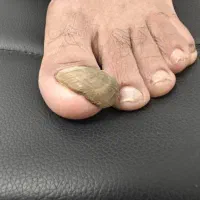 درمان ناخن فرو رفته تو گوشت و قارچی بدون درد