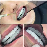 کامپوزیت، روکش ، عصب کشی