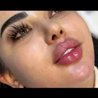 جشنواره تزریق ژل بوتاکس زاویه سازی فیلر لیفت نخ