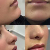 جشنواره پاییزی تزریق ژل و بوتاکس