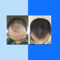 نگو که داری کچل میشی