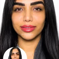ژل و بوتاکس و جوانساز بصورت اقساط۶ماهه(فقط چک)