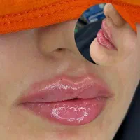 مدل برای تزریق لب و کانتور صورت